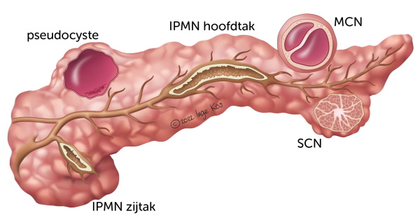 Pancreas met cysten