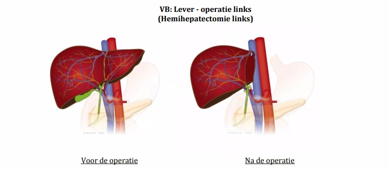 Hemihepatectomie