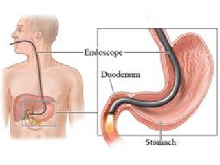 Tijdens een endoscopie wordt via de slokdarm en maag met een endoscoop in de dunne darm gekeken.