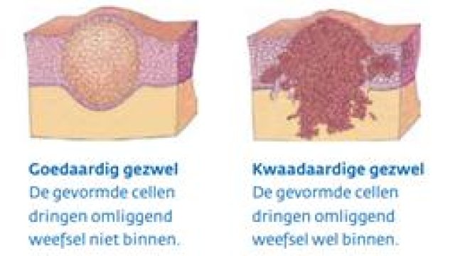 Om de juiste diagnose te kunnen stellen, moeten er onderzoeken worden uitgevoerd. © 2013 KWF Kankerbestrijding