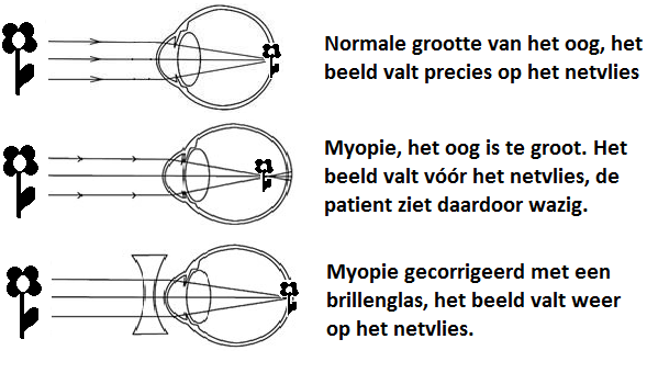 Myopie plaatjes