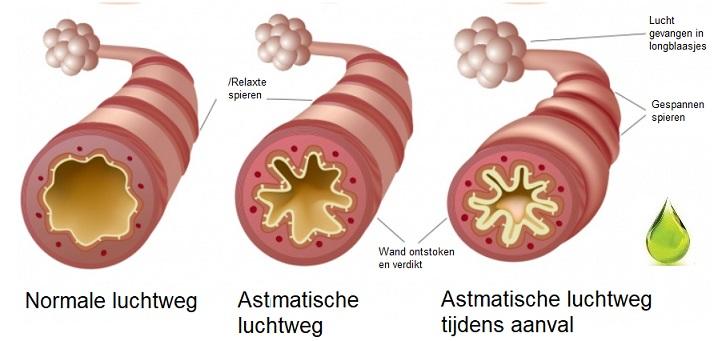 Astma - PGMCG