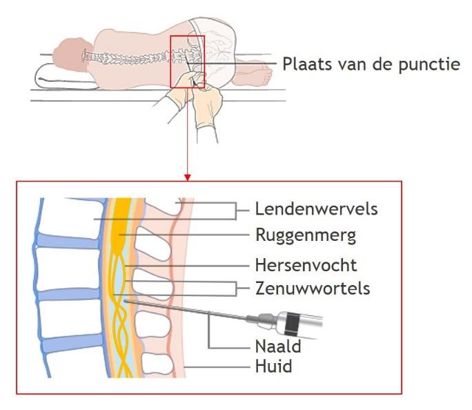 Lumbaalpunctie