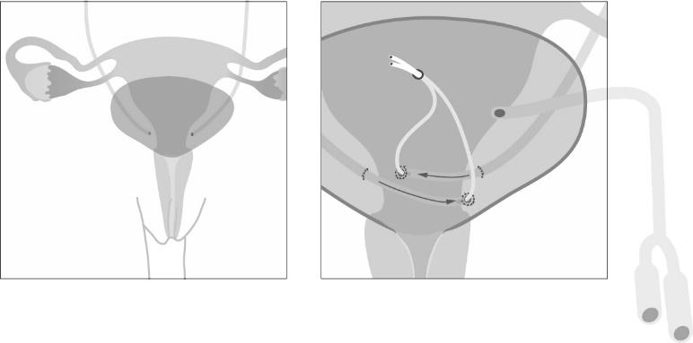 ureter reïmplantatie