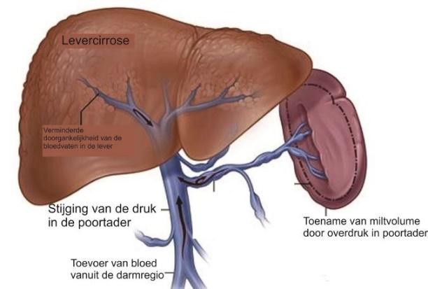 levercirrose